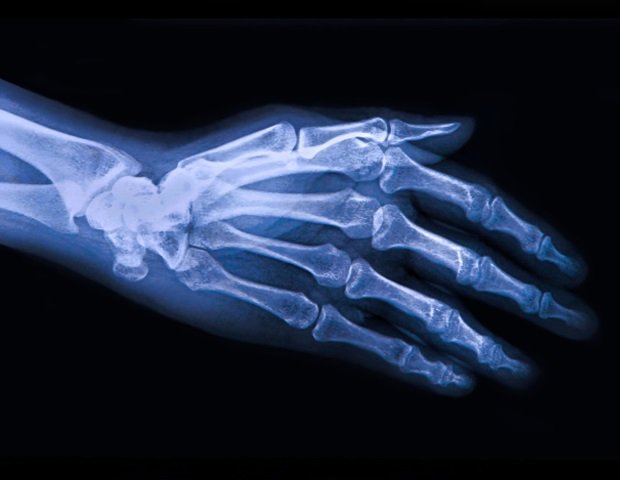 Osteoarthritis-620x480.jpg